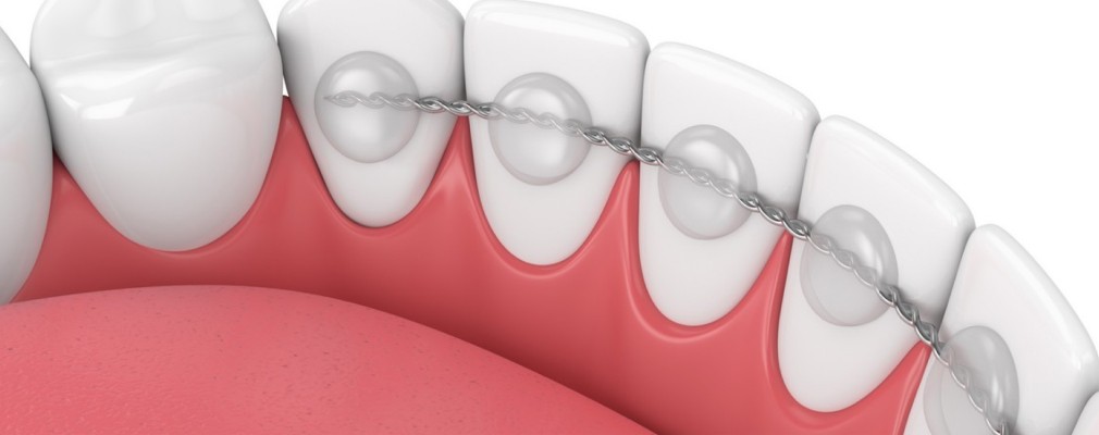 Contention orthodontique sur mesure