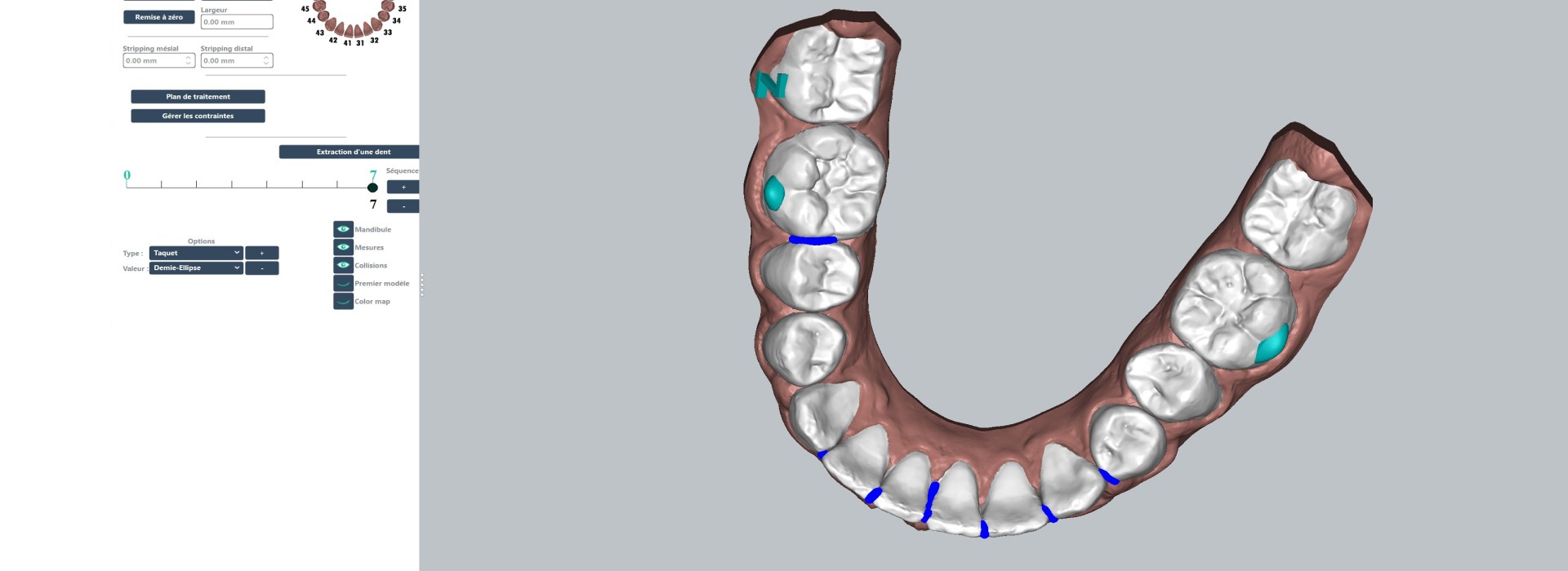 Dr Savard Paris 16 traitement logiciel planification orthodontique
