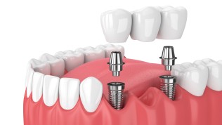bridge sur implant au Cabinet Dentaire Boissiere à Paris 16