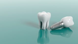 implants dentaires au Cabinet Dentaire Boissiere à Paris 16