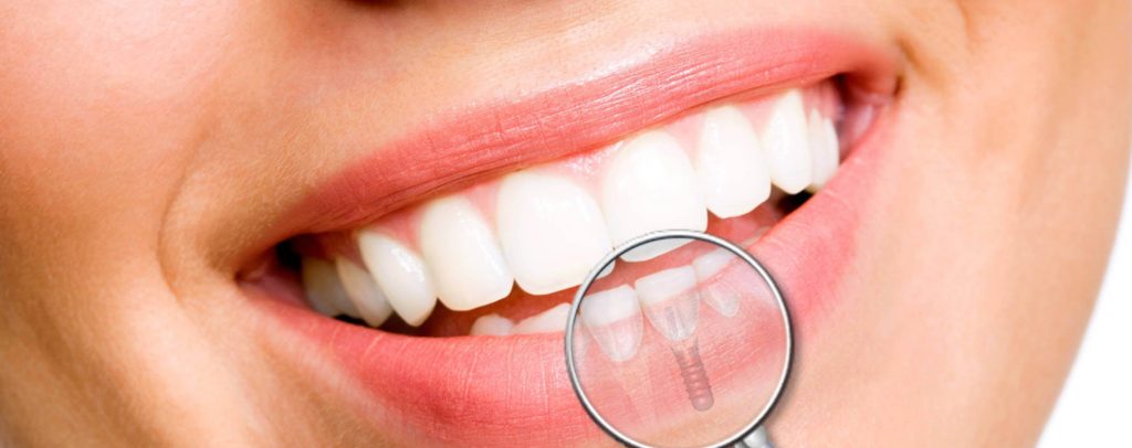 Implants Dentaires vs. Bridges Dentaires