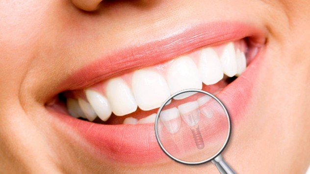 Implants Dentaires Bridges Dentaires au Cabinet Dentaire Boissiere à Paris 16